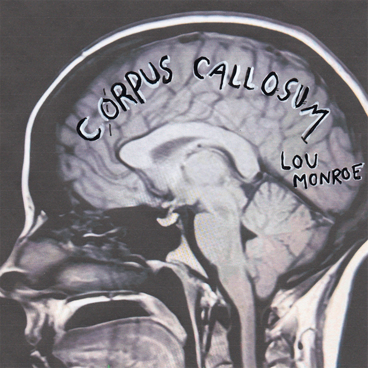 LOU MONROE_Corpus Callosum
